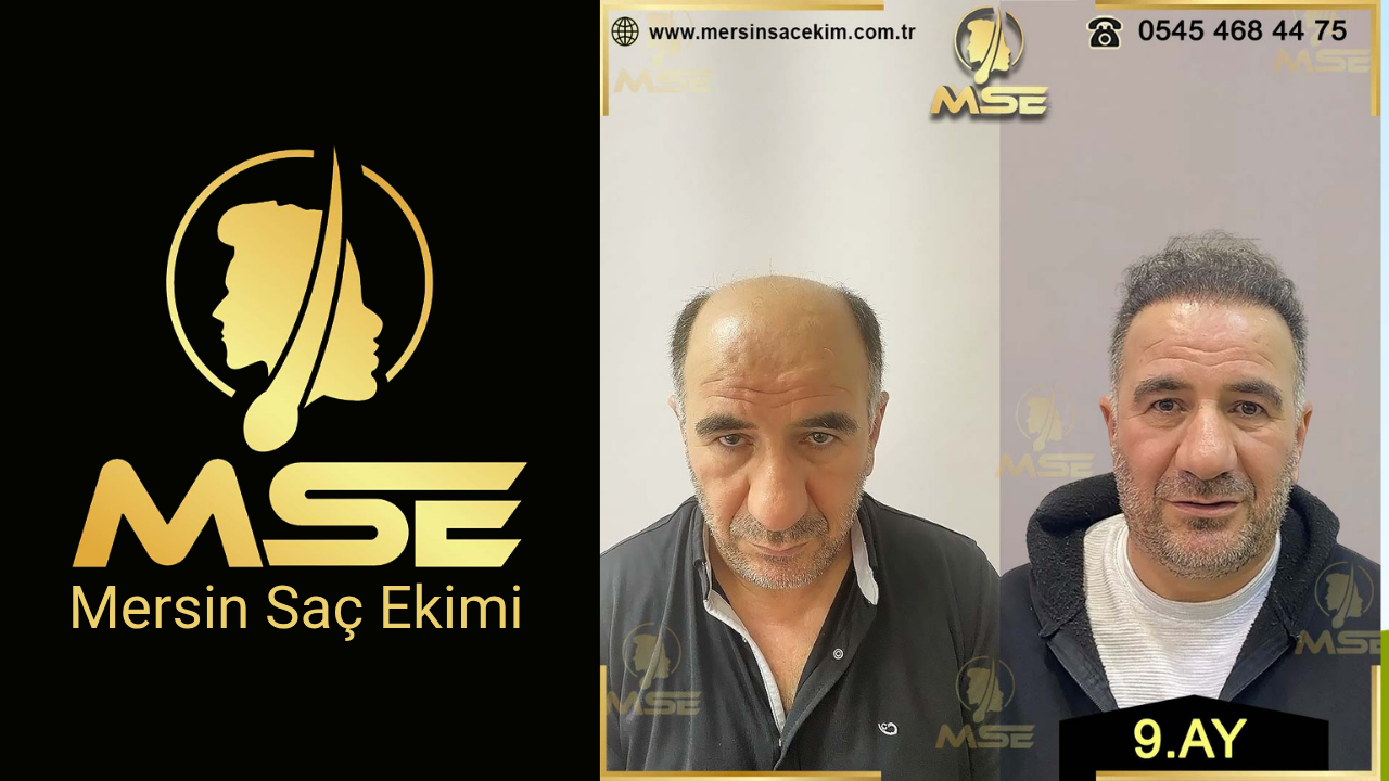 MERSİN SAÇ EKİMİ